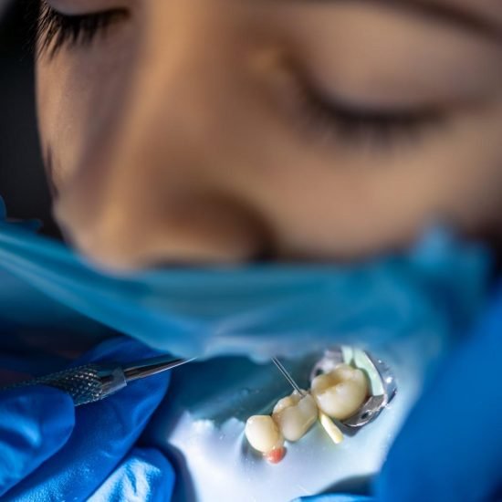 teeth filling and extraction