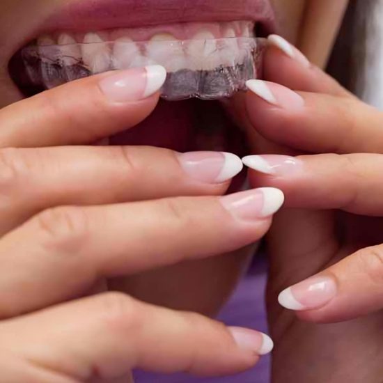 teeth aligners